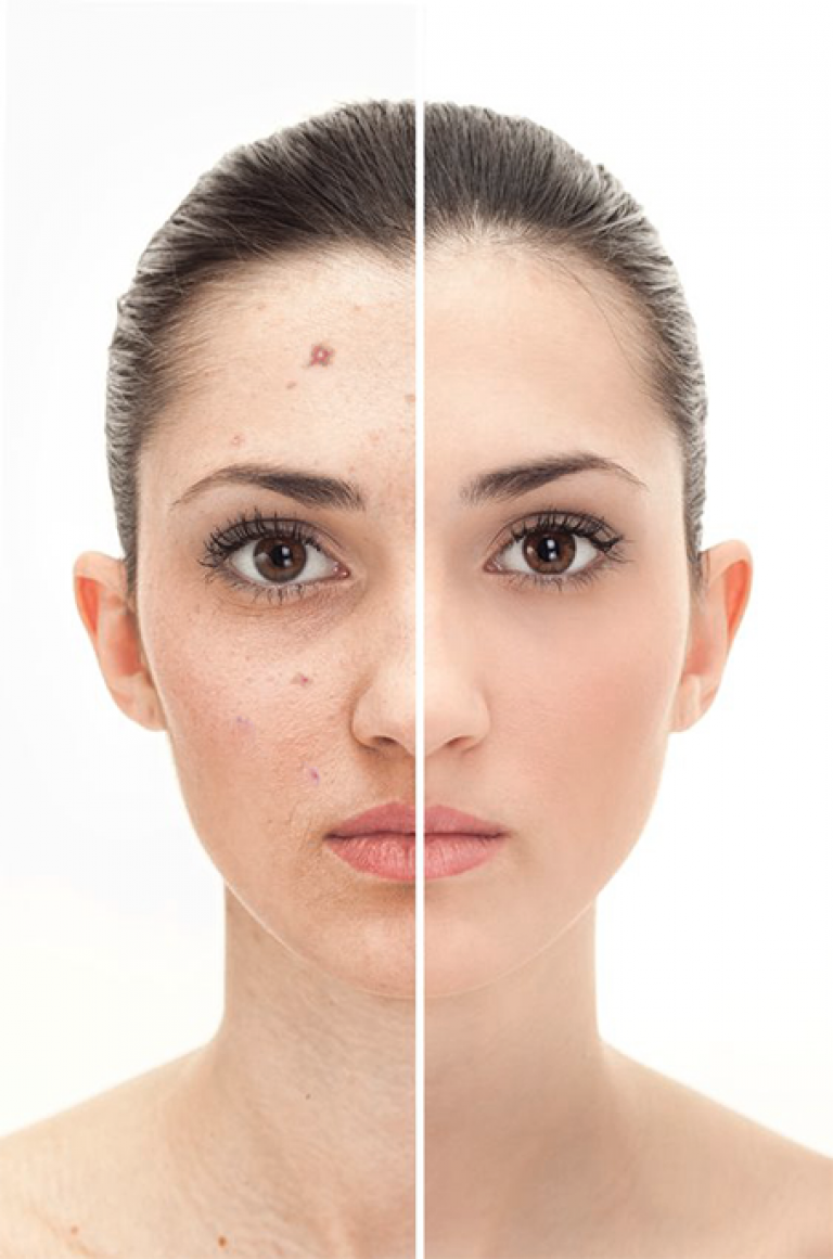 Lamprobe Machine LAMPROBE- Creating Flawless Skin - Information