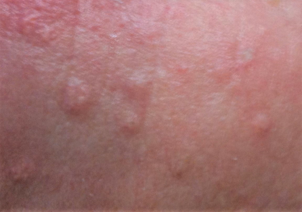 sebaceous glands bumps