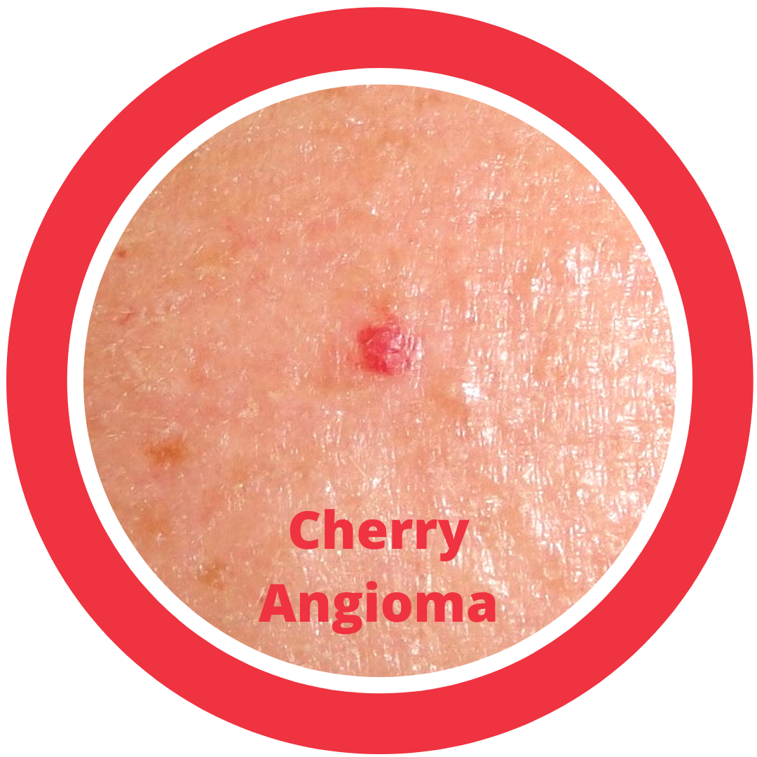 Cherry Angioma