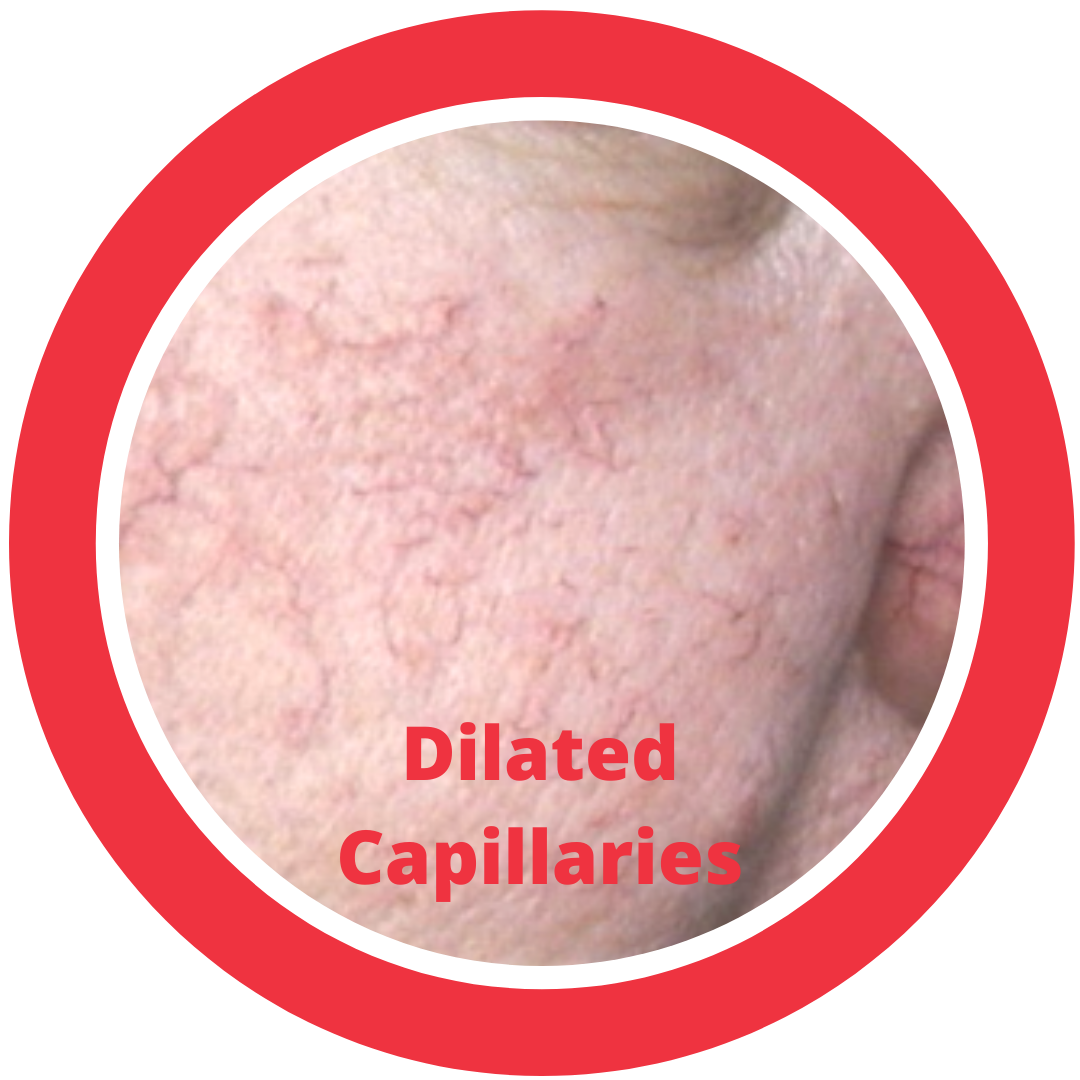 Dilated Capillaries
