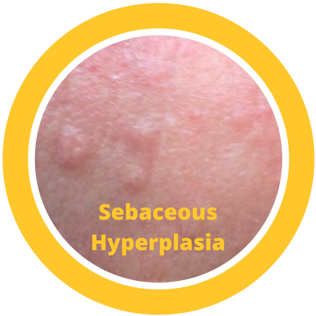 Sebaceous Hyperplasia