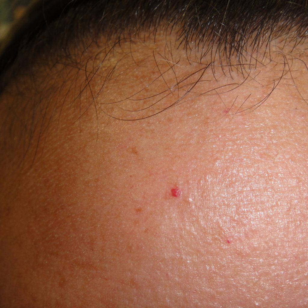 Cherry Angioma 135 Mb